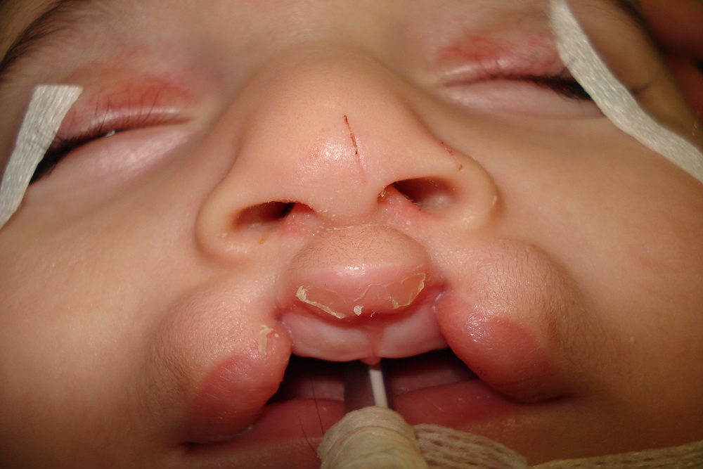 CLEFT LIP/PALATE 